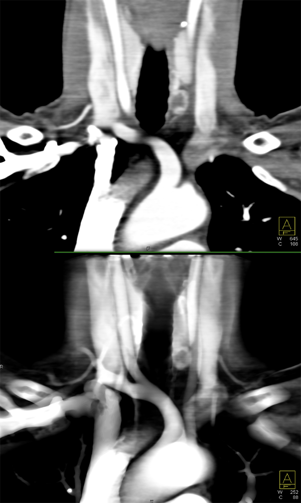 Ectopic Parathyroid Adenoma