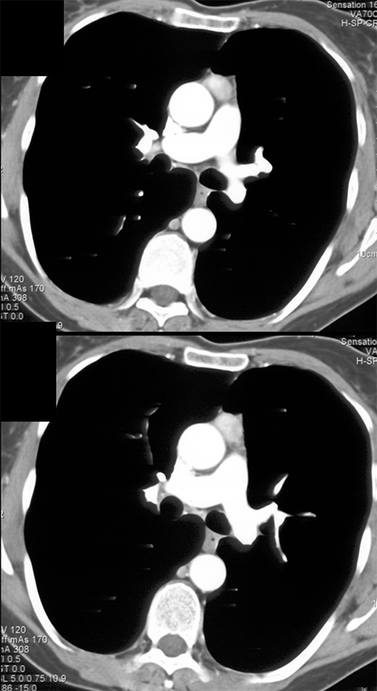 Ectopic Parathyroid Adenoma