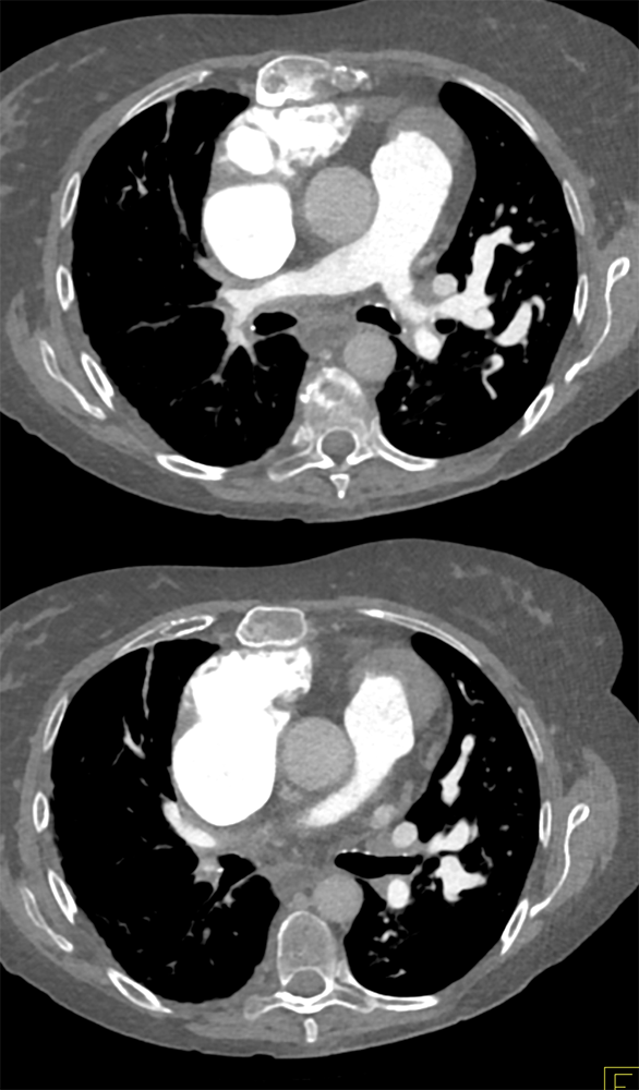 Fibrosing Mediastinitis Involves the Pulmonary Artery and Vein