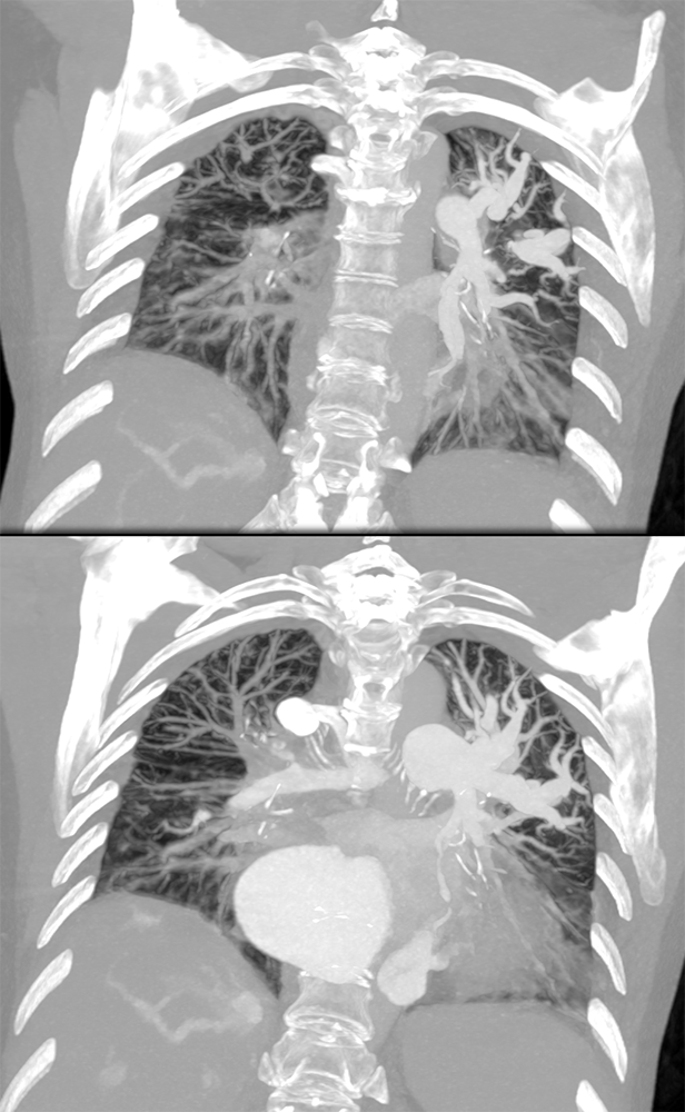 Fibrosing Mediastinitis Involves the Pulmonary Artery and Vein
