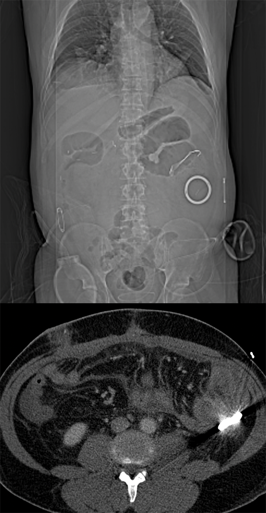 Missed Diagnosis on CT