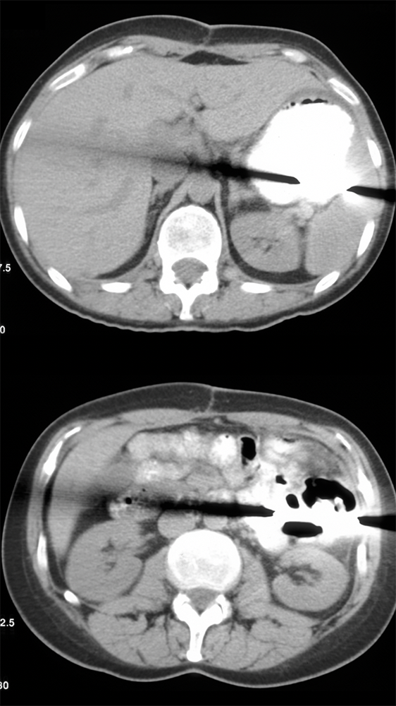 Post-Op Pain and Fever: ? Retained Barium