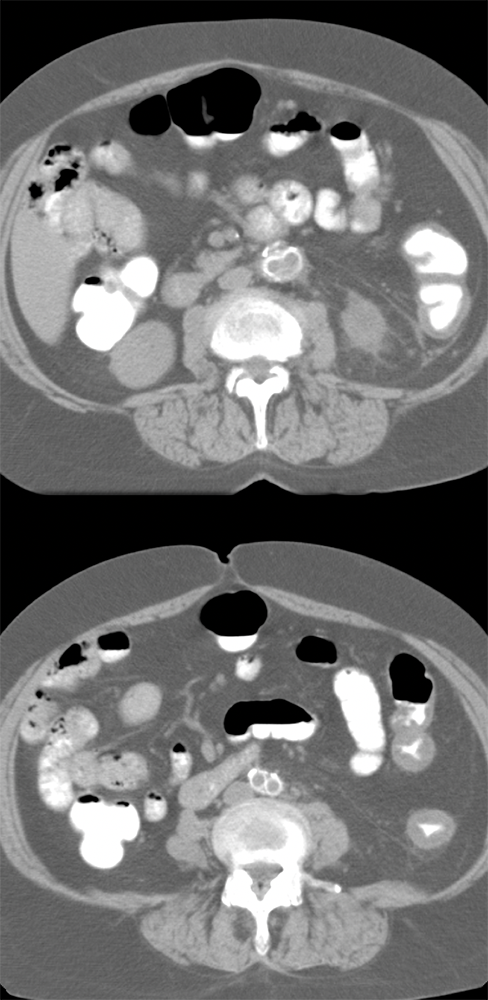 Missed Bladder Cancer in Patient with Ischemic Colitis ( 2 studies 3 years apart)