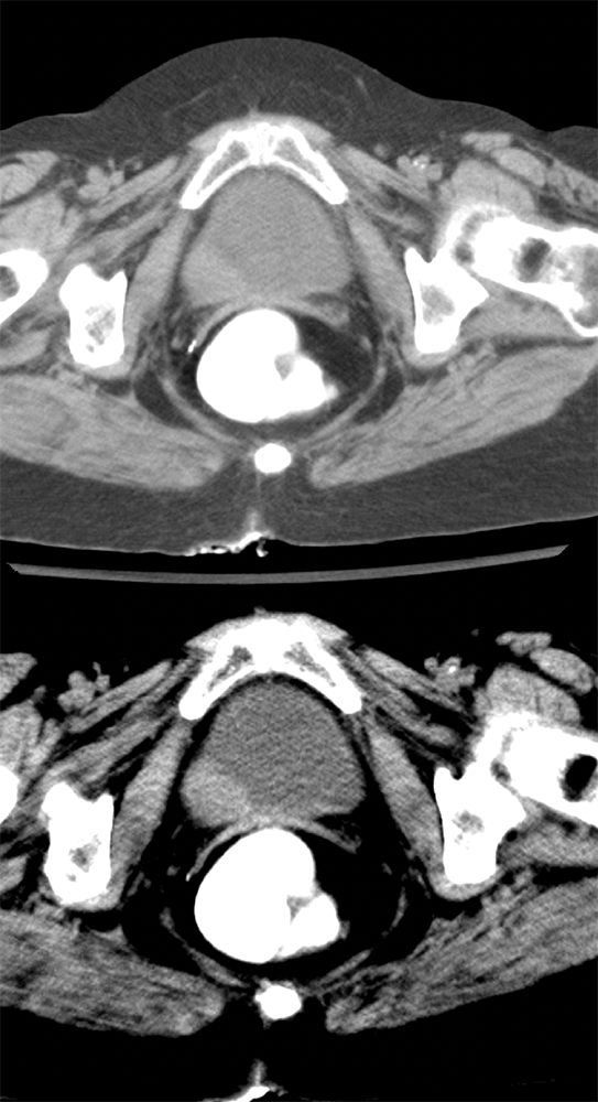 Missed Diagnosis on CT