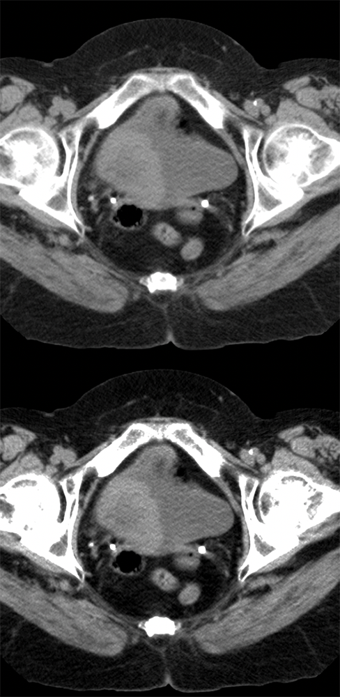 Missed Diagnosis on CT