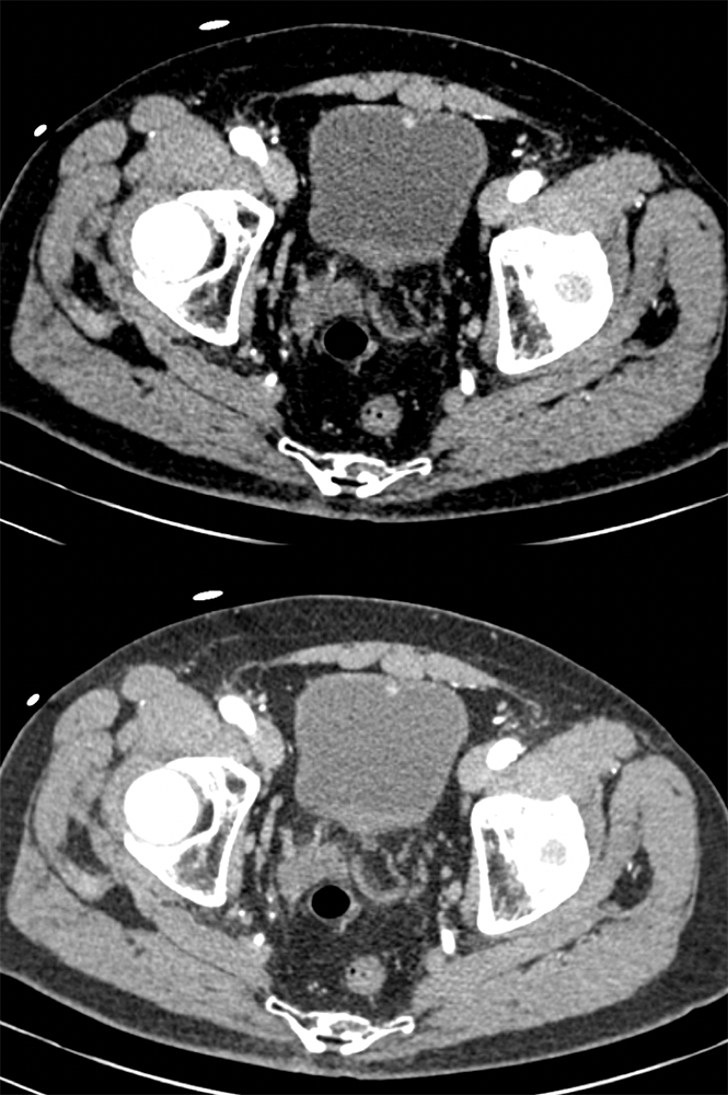 Incidental Bladder Cancer