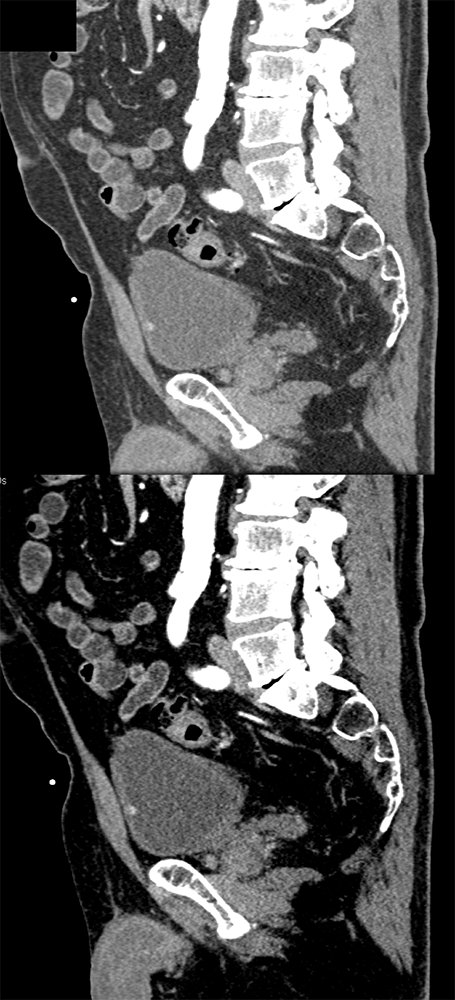 Missed Diagnosis on CT