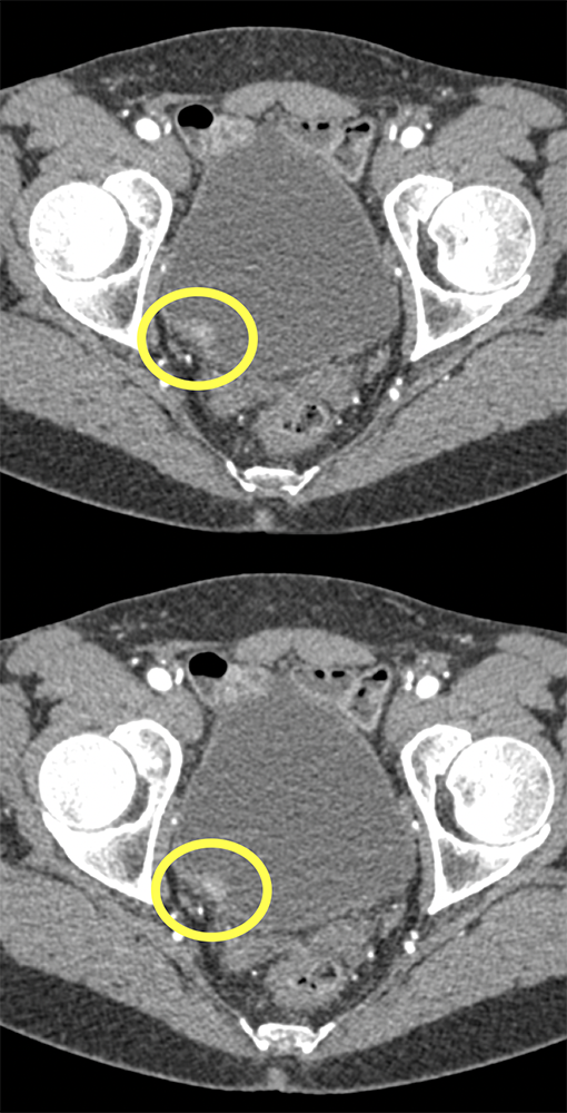 Incidental Bladder Cancer