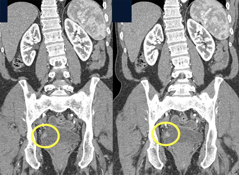 Missed Diagnosis on CT