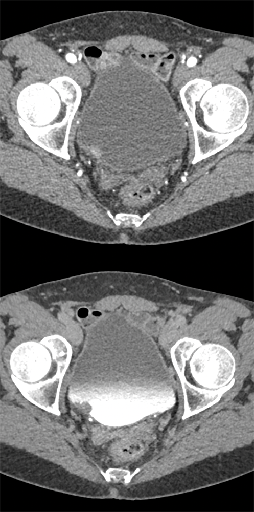 Missed Diagnosis on CT