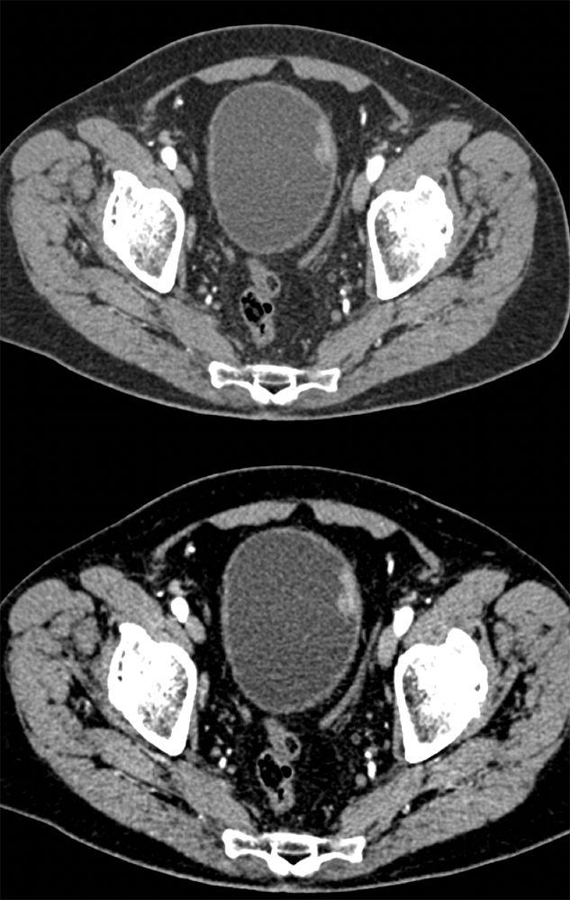 Missed Diagnosis on CT