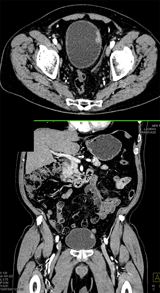 Missed Diagnosis on CT