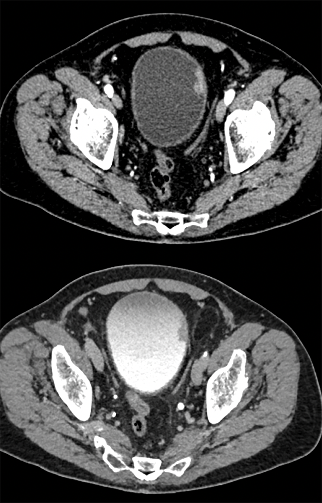 Missed Diagnosis on CT