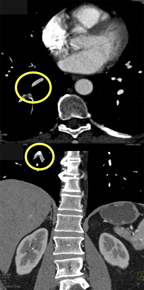 Missed Diagnosis on CT