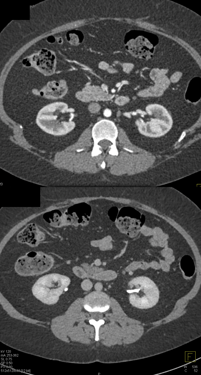 TCC Proximal Ureter