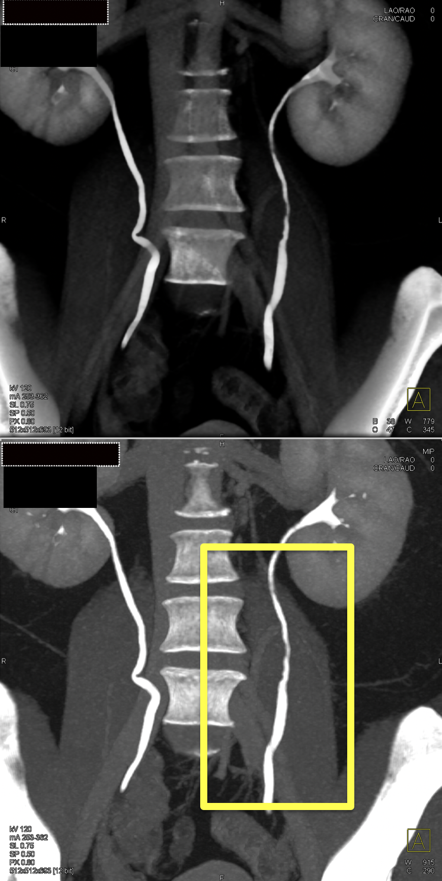 Missed Diagnosis on CT