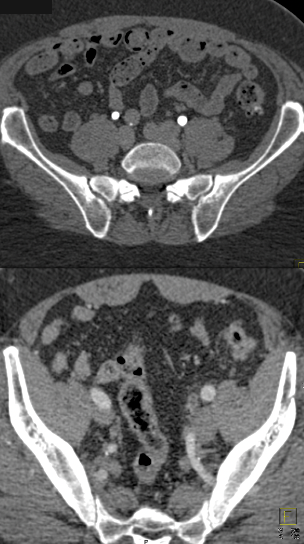 Subtle TCC Left Ureter