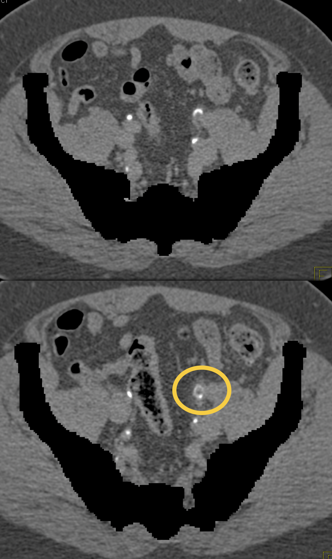 Missed Diagnosis on CT