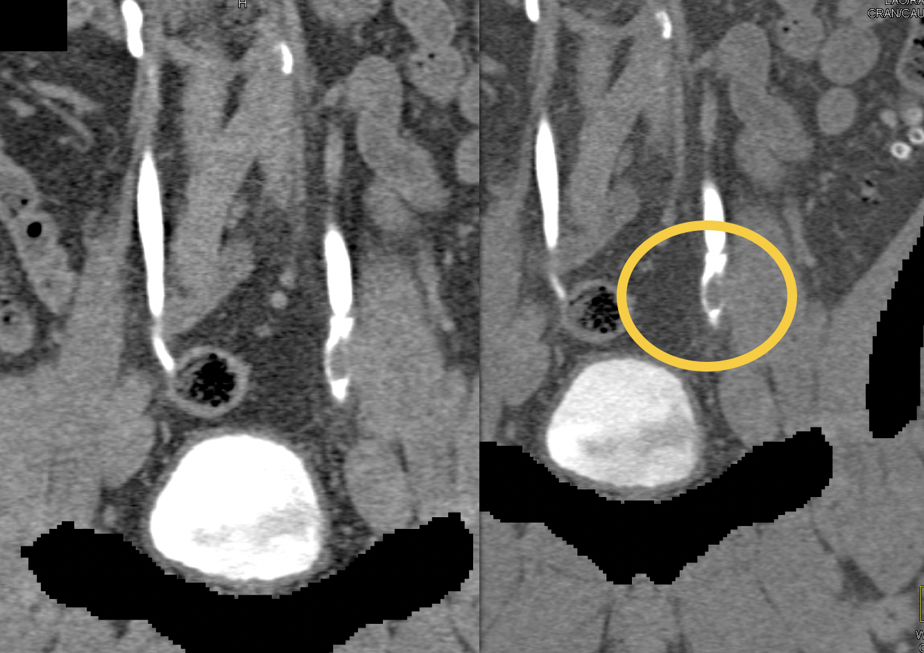 Missed Diagnosis on CT