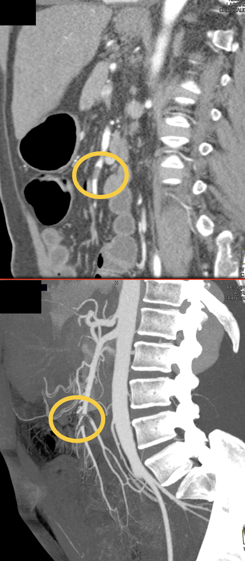 SMA Thrombus