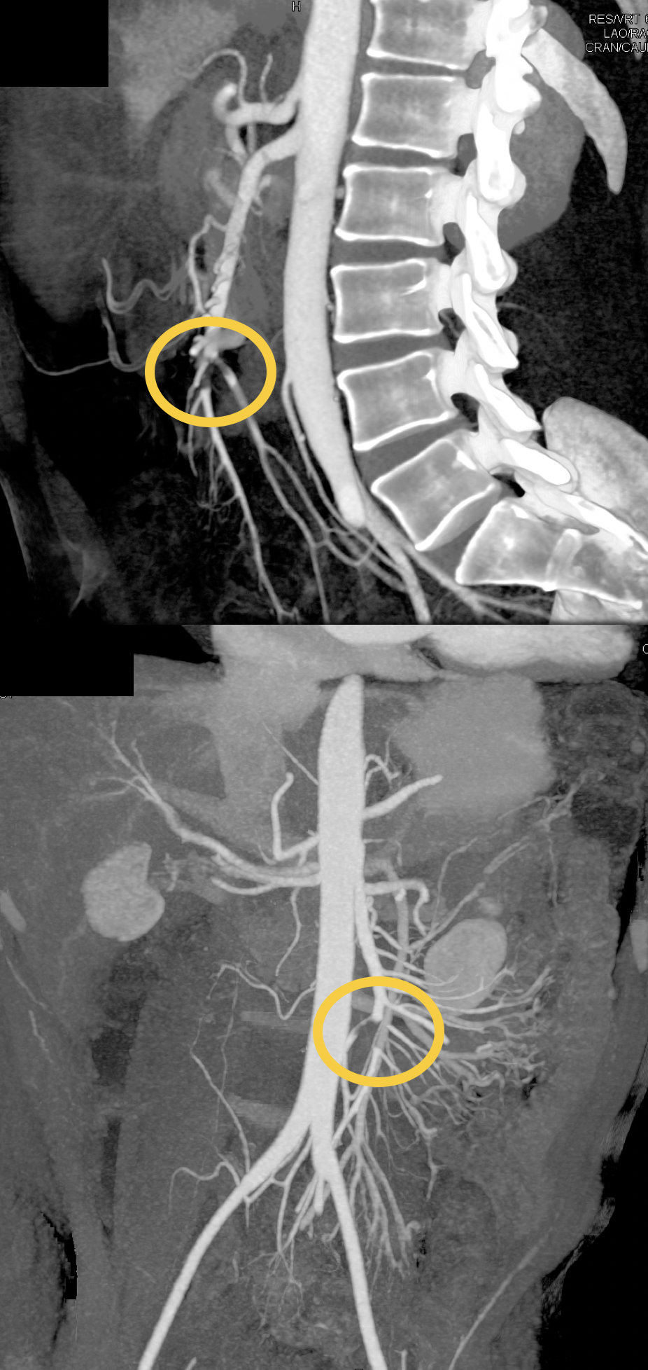 Missed Diagnosis on CT