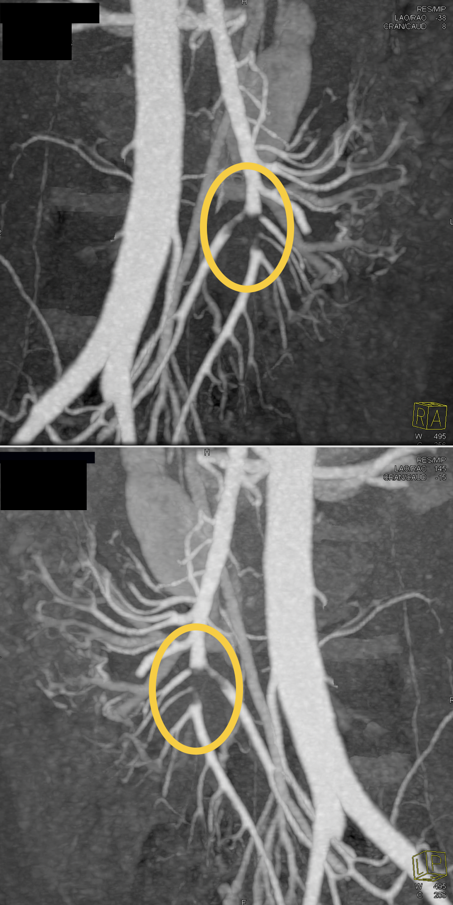 Missed Diagnosis on CT