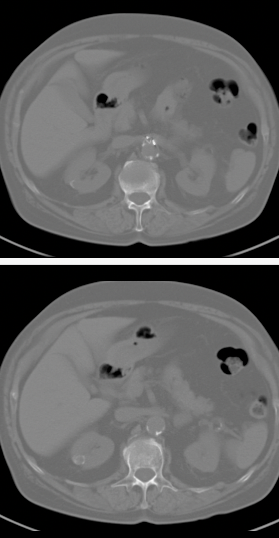 Missed Diagnosis on CT