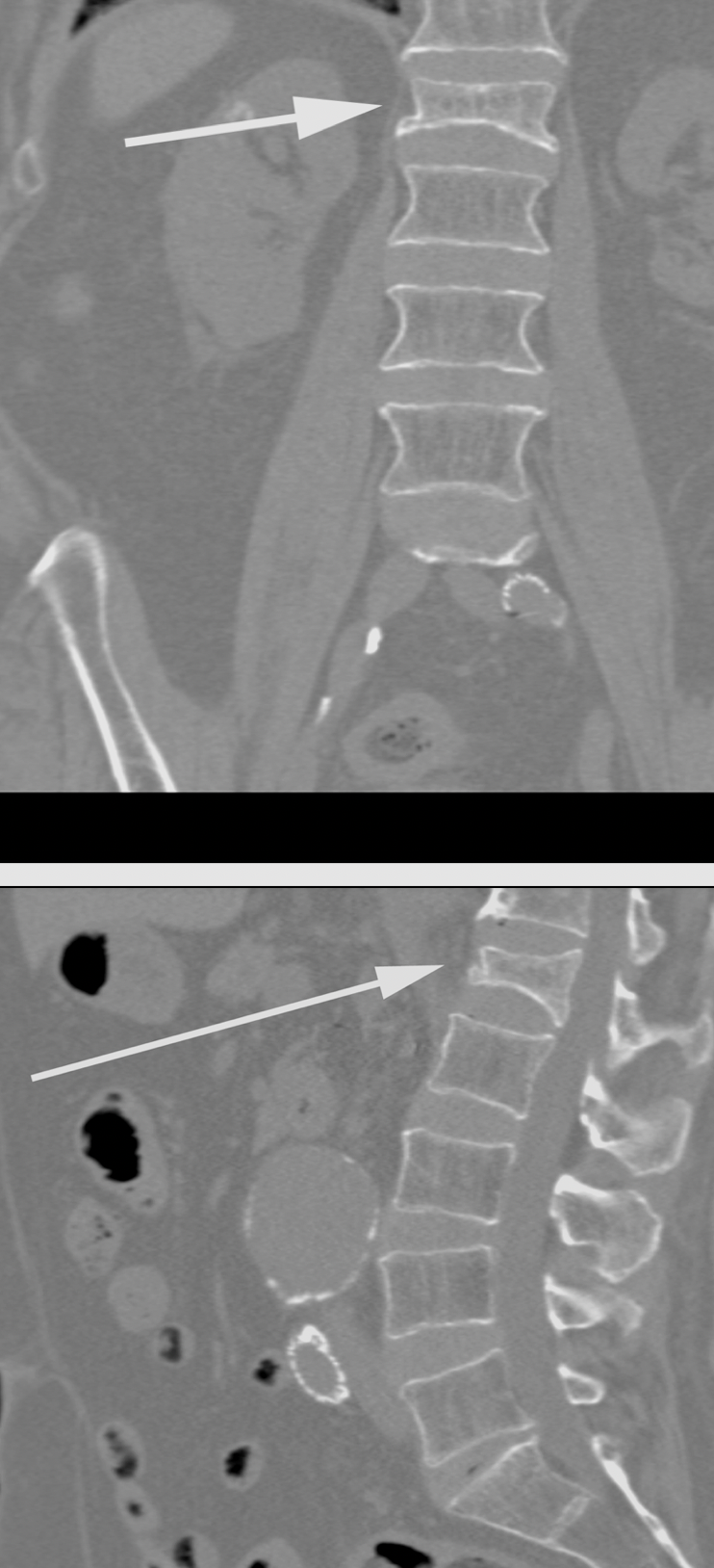 Missed Diagnosis on CT