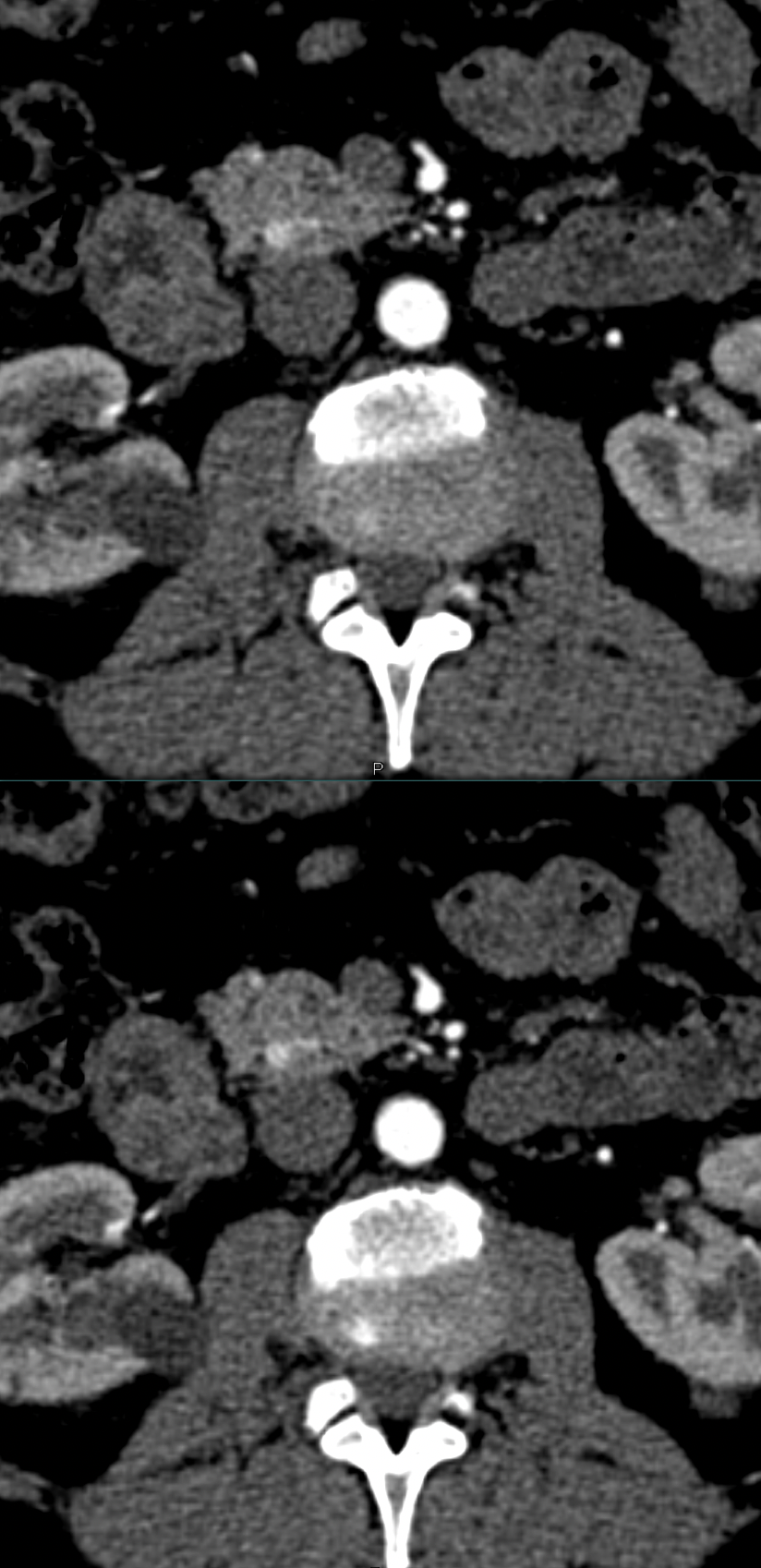 5 mm Neuroendocrine Tumor HOP