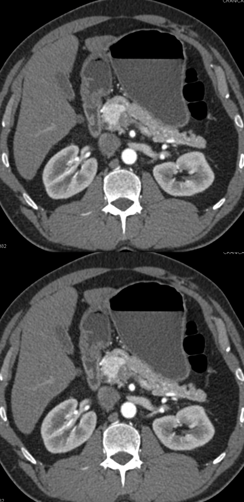 Neuroendocrine Tumor HOP Seen Only On Arterial Phase