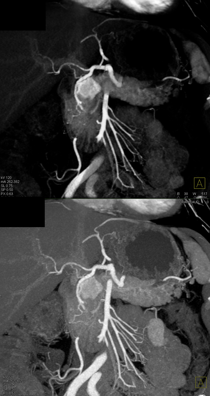 Missed Diagnosis on CT