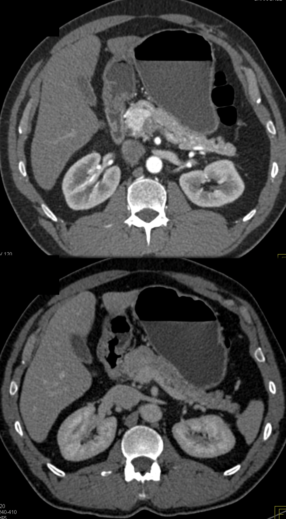 Missed Diagnosis on CT