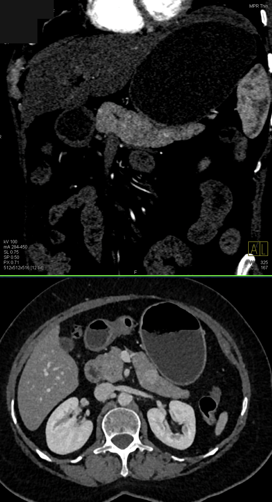 Missed Diagnosis on CT