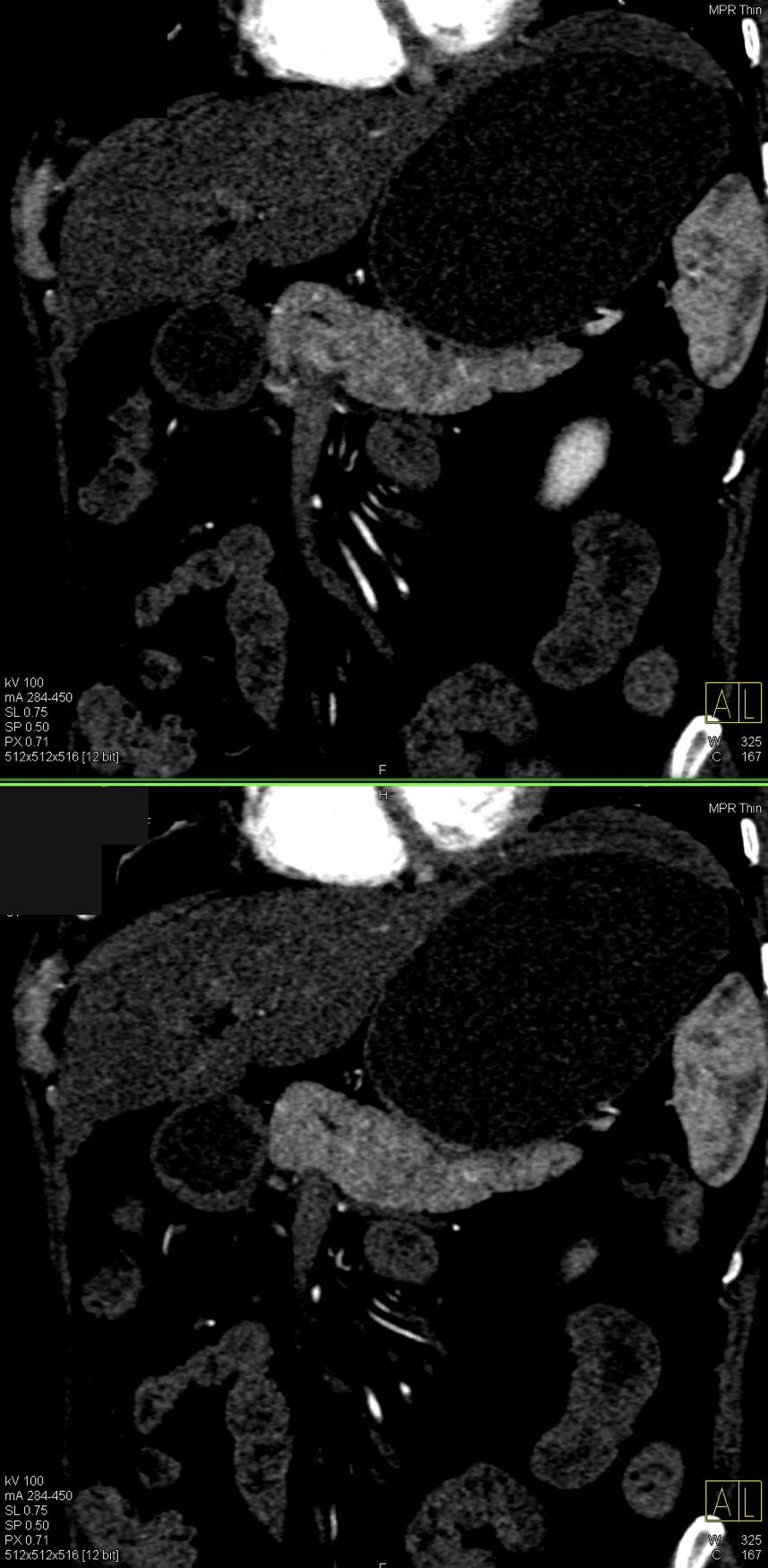 Missed Diagnosis on CT