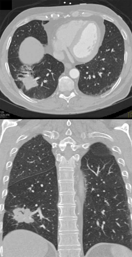 Missed Diagnosis on CT