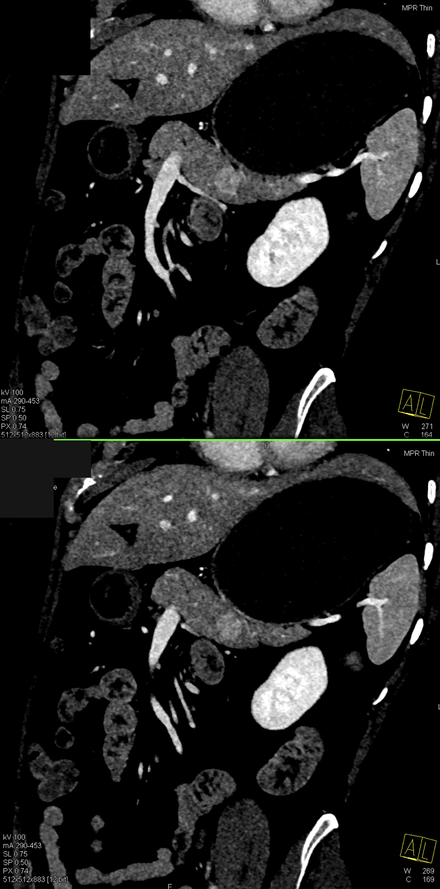 Missed Diagnosis on CT