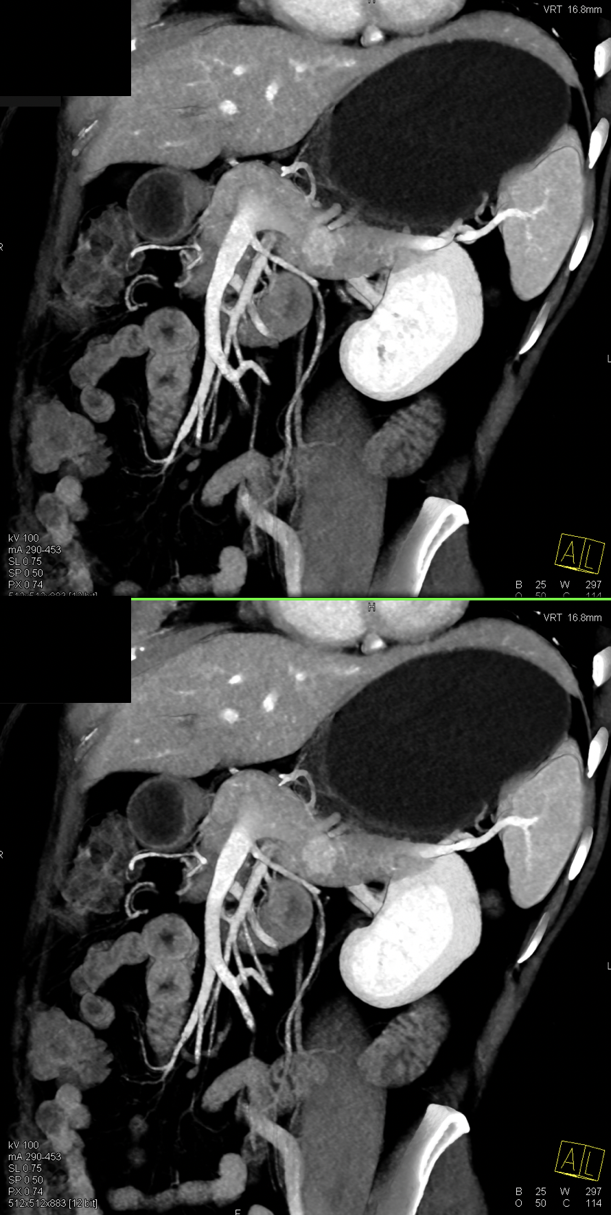 Missed Diagnosis on CT