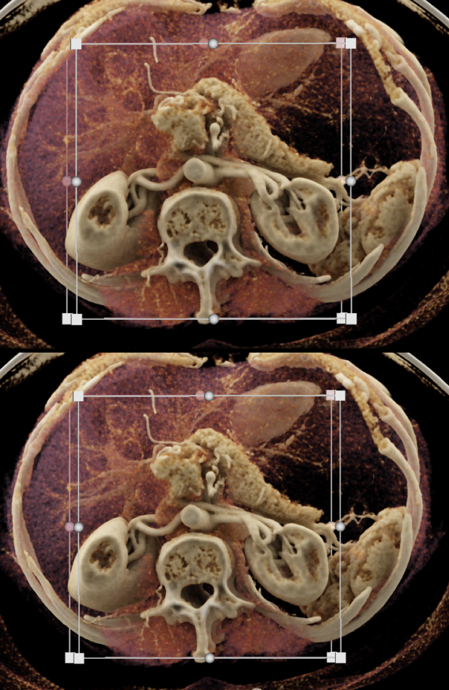 Missed Diagnosis on CT