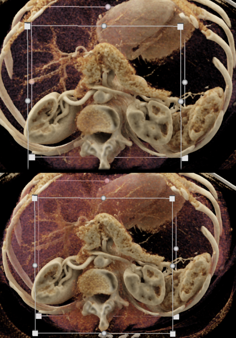 Missed Diagnosis on CT