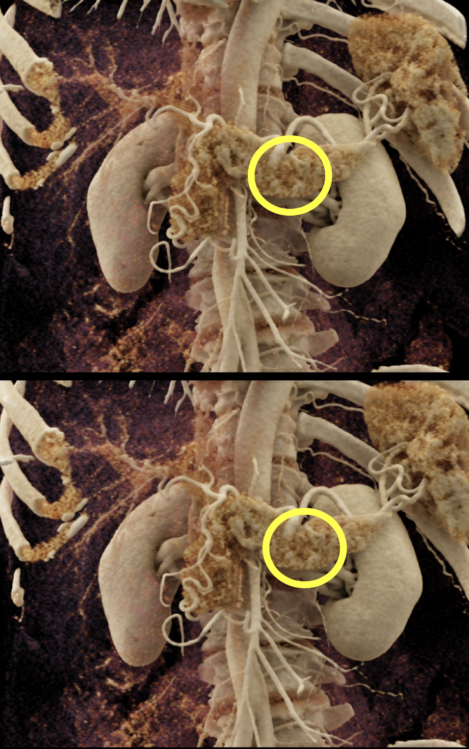 Missed Diagnosis on CT