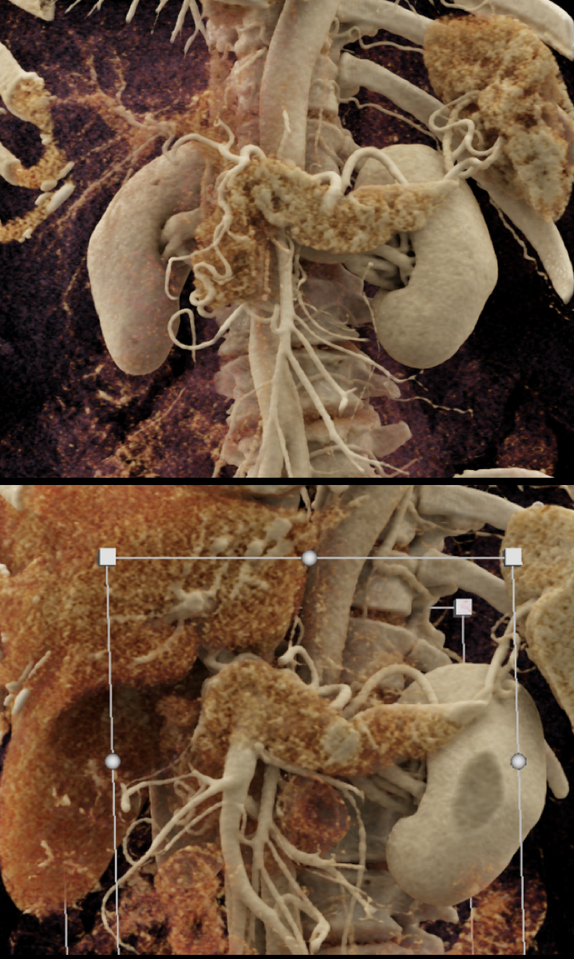 Missed Diagnosis on CT