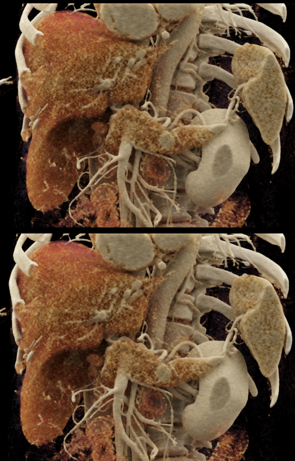 Missed Diagnosis on CT