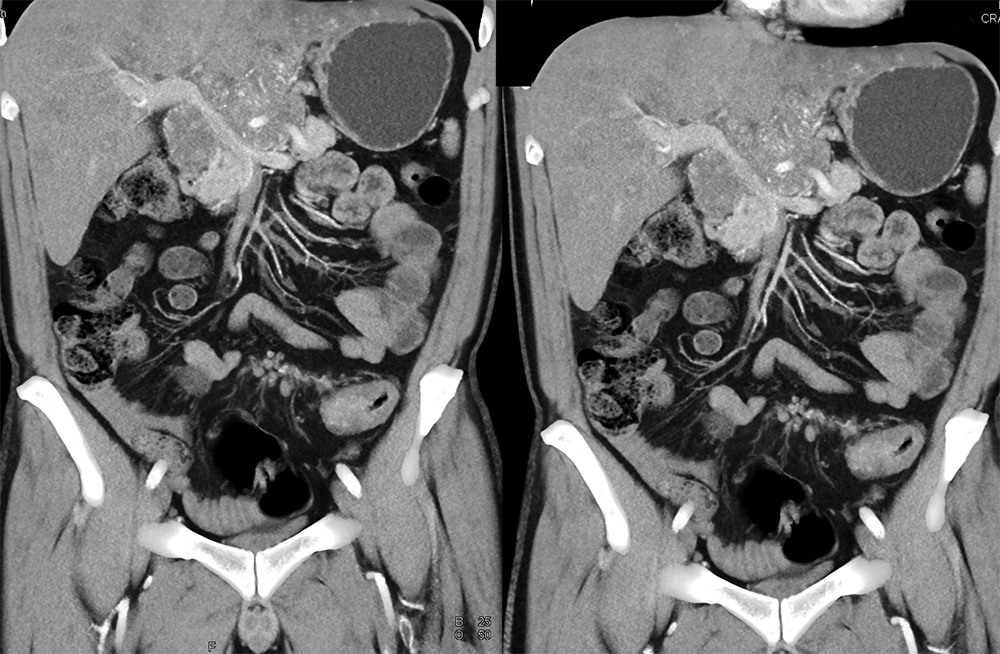 Detection of Pancreatic Cancer