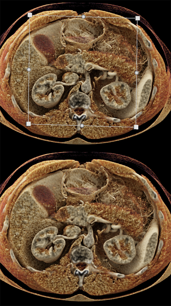 Autoimmune Pancreatitis