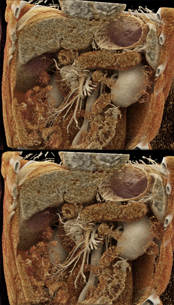 Detection of Pancreatic Cancer