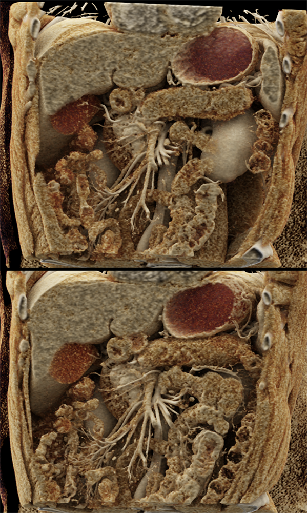 Detection of Pancreatic Cancer