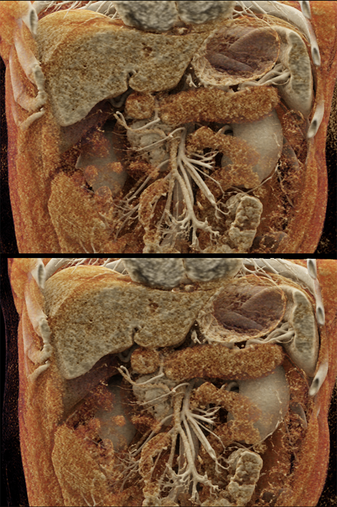 Detection of Pancreatic Cancer