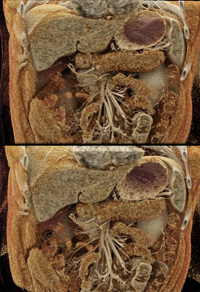 Detection of Pancreatic Cancer