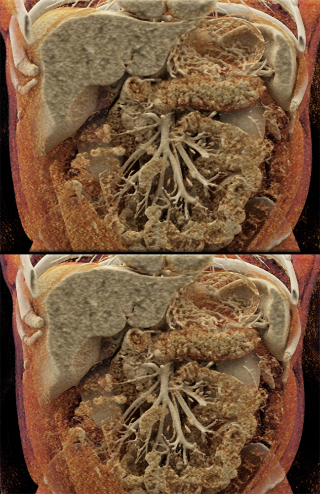 Detection of Pancreatic Cancer