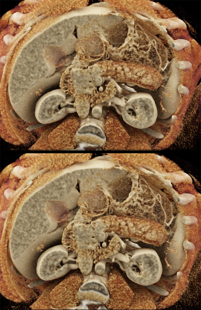 Detection of Pancreatic Cancer